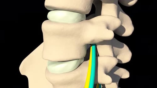 3D Animation of Lumbar Disc Herniation and Nerve Compression
