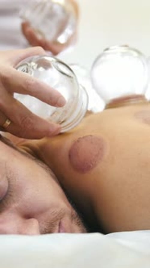 Man Receiving Cupping Therapy Treatment in a Wellness Center