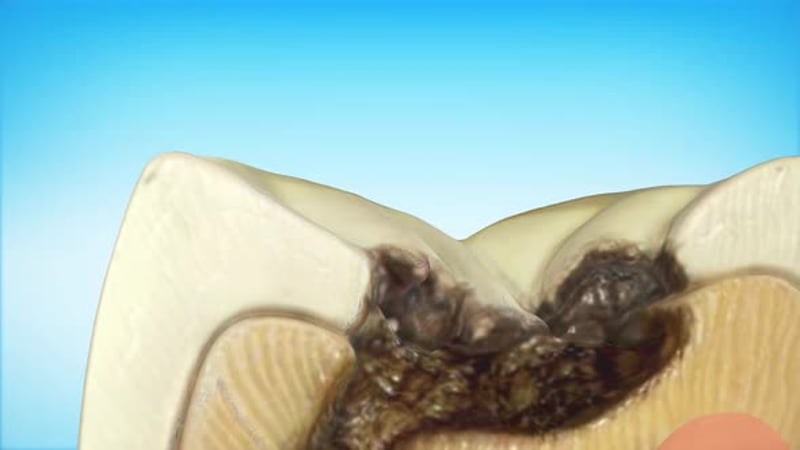 Animated Tooth Extraction and Jaw Healing Process, Bugs Motion Graphics ...