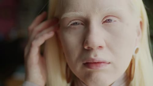 Modern Girl With Albinism Close-up