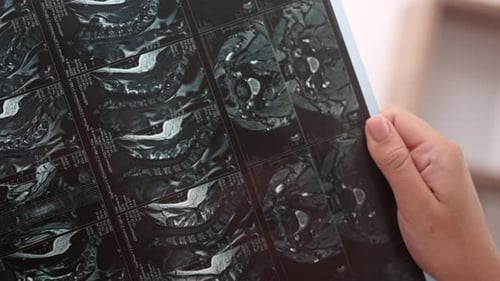 Close Up Doctor Hands Examining Patient Xray Films and MRI Scans with Vertebral Column