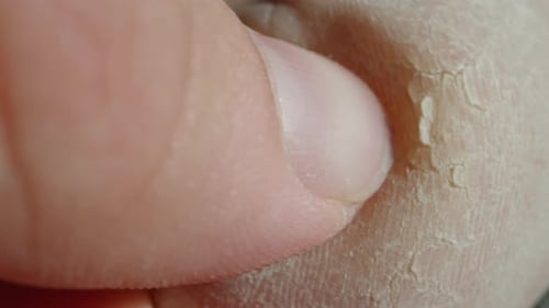 A man picks his old skin on his heels, a super close-up of a crack in his leg.