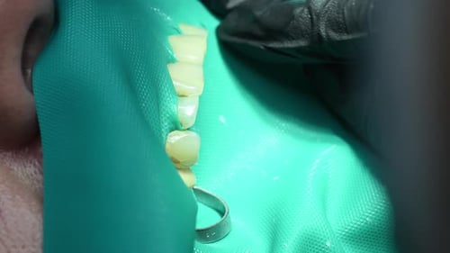 Dental Extreme Close Up Macro Video Dentist Treat Patient Teeth Orthodontist Works with an Assistant