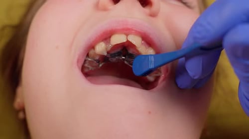 Setup orthodontic plate in child mouth. Mechanism to straight teeth. Dentist in gloves. Healthcare