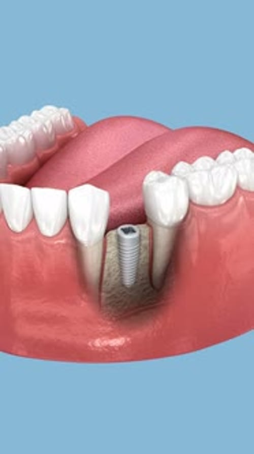 3D Animation of Dental Implant Installation and Crown Placement