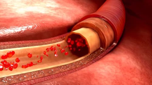 Blocked artery with restricted blood flow