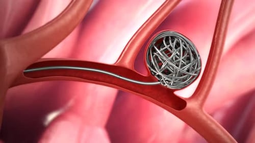 3D Medical Animation of Aneurysm Coiling Procedure