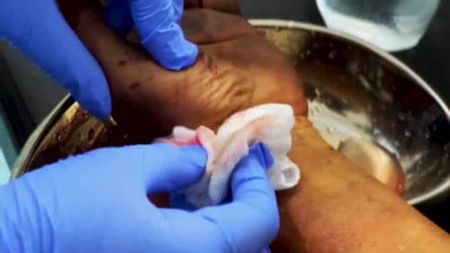 Cleaning Wound on Arm