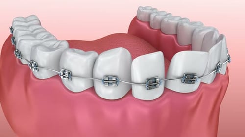Animated 3D Model of Orthodontic Braces Correcting Teeth