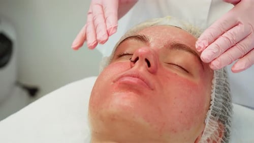 Red Skin of Woman Treated with Gentle Touch By Gloved Hands During Facial Therapy Female