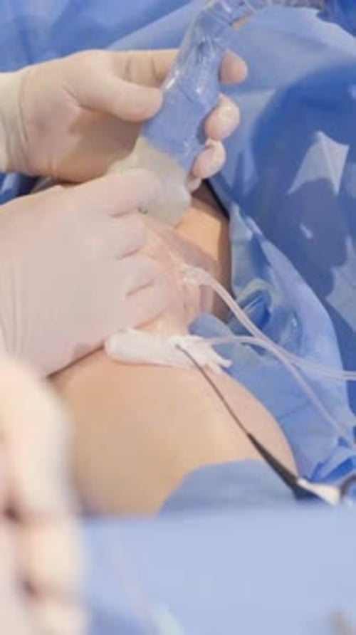 El proceso de operación realizado por un grupo de personal médico (Vídeo vertical de Doctors Vertical)