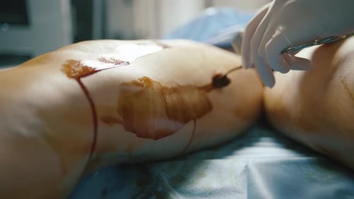 Surgeon performing vein surgery on patient in hospital operating room