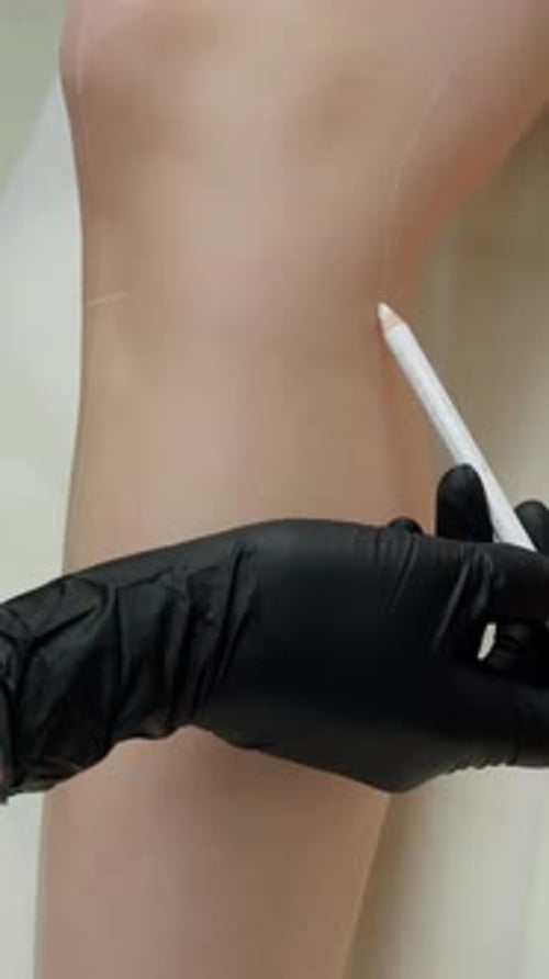 Marking Leg With Pencil For Cosmetic Surgery