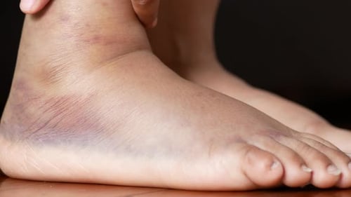 Close Up of Women Feet with Swelling