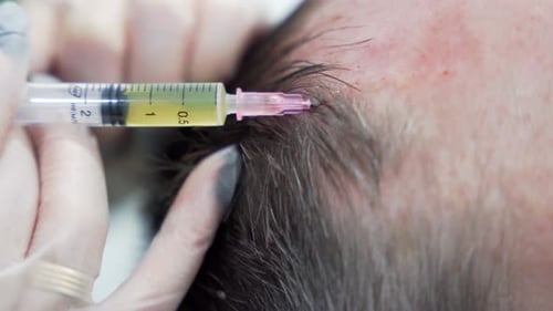 Macro Shot of Hair Mesotherapy Procedure in the Modern Cosmetology Clinic Plasma Injectiions Middle