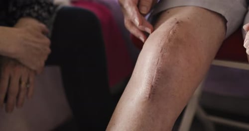 Senior Shows Scar on Knee After Operation