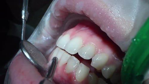 Dental Extreme Close Up Macro Video Dental Cleaning Process in Patient Mouth Clean Teeth with Water