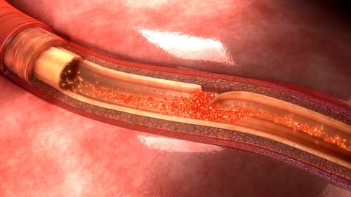 Medical illustration of a ruptured blood vessel and hemorrhage