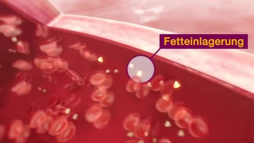 Medical visualization of plaque buildup in human arteries