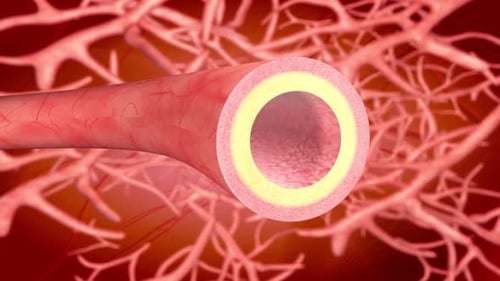 Artery Plaque Clearing in Blood Vessel Medical Animation