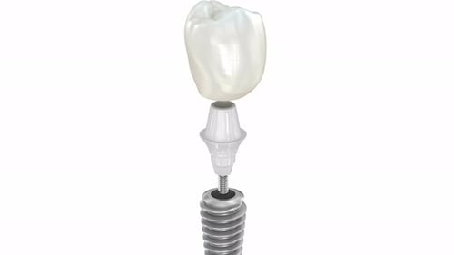 3D Dental Implant Disassembly And Reassembly Animation