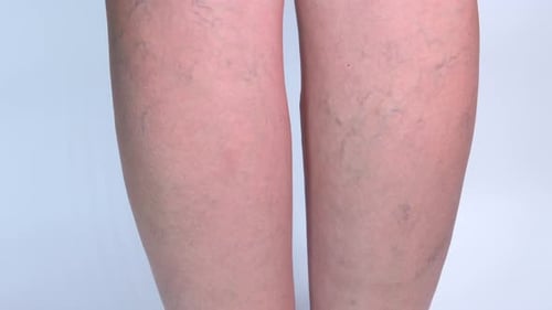 Las venas varicosas en las piernas se acercan sobre un fondo blanco