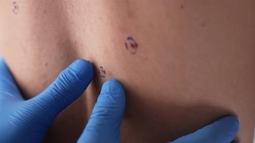 Arzt untersucht markierten Maulwurf am männlichen Torso