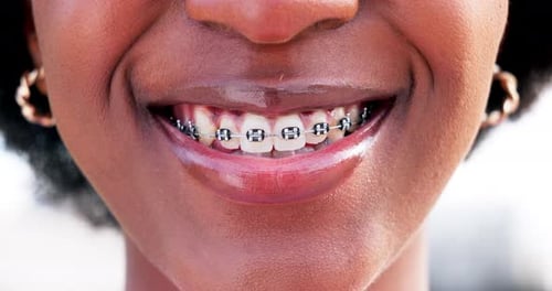 Smiling Woman Showing Braces on Teeth Close Up