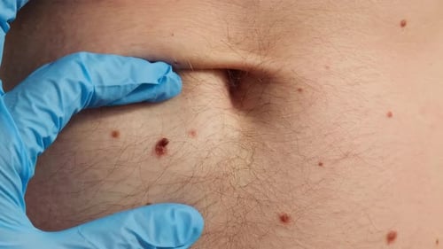Arzt in medizinischen Handschuhen untersucht Mann, Hautfleck, Hautarzt, untersucht männliche Muttermale, Selbstpflege