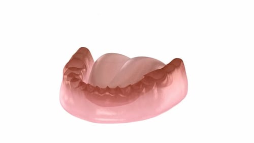 3D Animation of Dental Implant Placement in Human Jaw