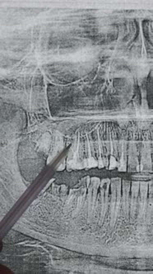 Close Up Teeth and Jaw X-Ray
