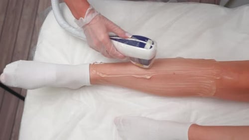 Laser Hair Removal Treatment on a Woman's Leg