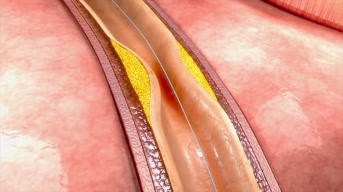 Medical procedure placing coronary artery stent