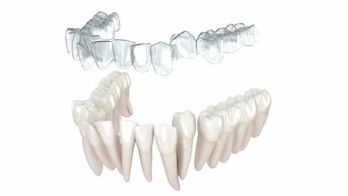 3D Animation of Transparent Dental Aligner Applying to Teeth