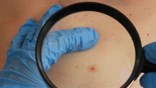 Mole Dermoscopy Preventive of Melanoma Dermatologist Examining Patient's Birthmark with Magnifying