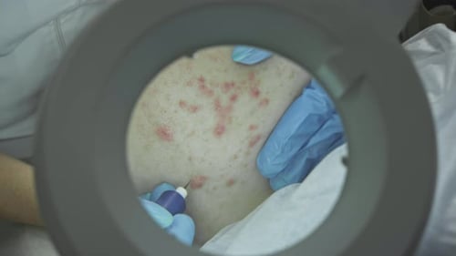 Kosmetologischer Eingriff Operation Der Arzt behandelt Problemhaut mit Pickeln und Akne-Laser für