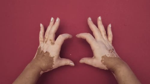 Woman Hands with Vitiligo Pigmentation Show Heart on Pink