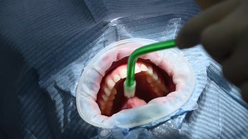 Vidéo macro Dental Extreme Close Up Processus de nettoyage dentaire chez le patient : nettoyez les dents et les gencives