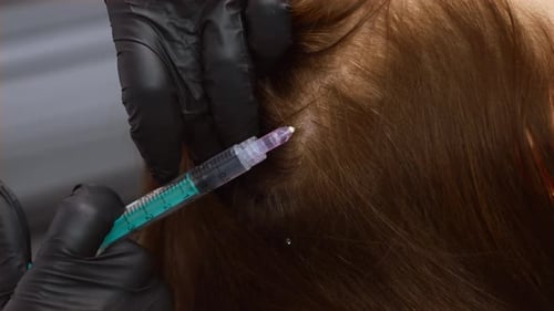 Scalp Injection Treatment for Hair Growth