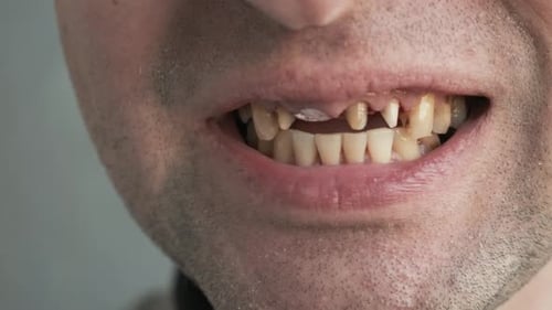 Man with Bad Diseased Teeth Affected By Caries and Periodontitis Smoker Yellow Teeth Male Touch His