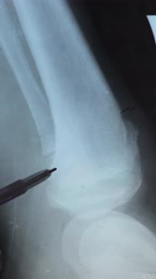 Vertical video of a Doctor examining X-ray of the knee joint