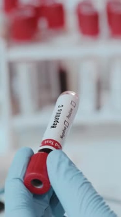 Healthcare Professional Examining Hepatitis C Blood Test Tube in Clinic