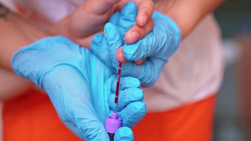 Blood Sample Drawn with Capillary Tube in Hospital
