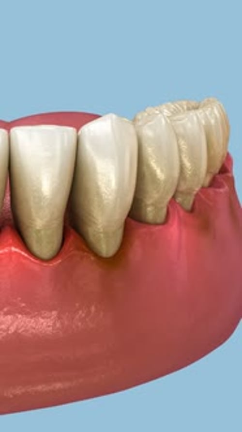 Periodontal - pathological inflammatory condition of the gum in progress