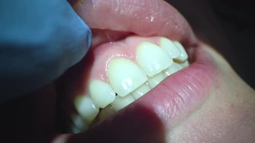Dental Care Extreme Close Up Macro Video Dentist Treat Patient Teeth Orthodontist Works with
