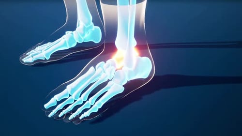 3D Medical Animation of Human Ankle Joint Pain