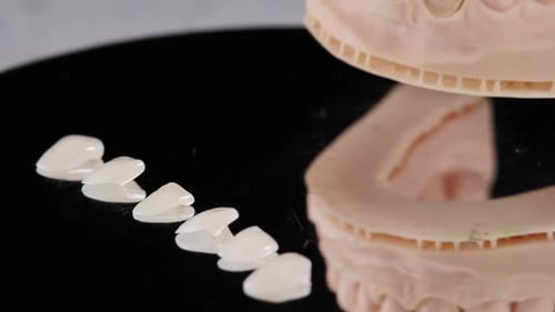 Dental Veneers and Dental Mold close up