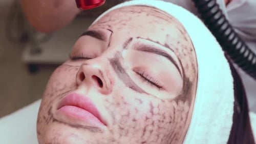 Woman Receives Carbon Laser Peel Facial Treatment