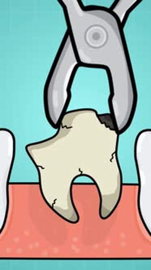 Tooth Extraction Dental Medical Animation Vertical