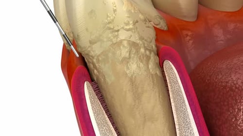 Dental Probe Measuring Periodontal Pockets 3D Animation